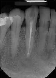 Check spelling or type a new query. Difficulties In The Diagnosis Of Periapical Translucencies And In The Classification Of Cemento Osseous Dysplasia Bmc Oral Health Full Text