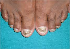 Image result for onychomycosis