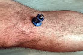 Image result for Intraosseous Access