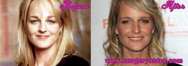 At the moment, we cannot confirm helen hunt plastic surgery. Helen Hunt Plastic Surgery Before After Pictures