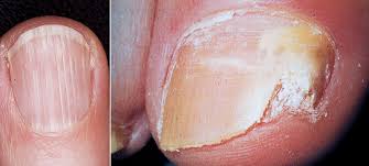 Image result for mykoza nehtů