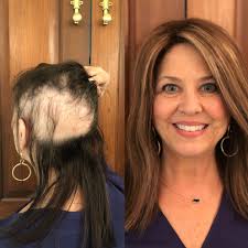 Lea Michele shares photo of postpartum hair loss: What moms need to know