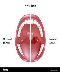 Image result for tonsilla palatina