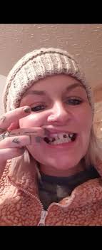 Smile improvement journey with lab procedure