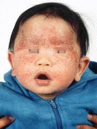 Image result for dermatitis contacta children