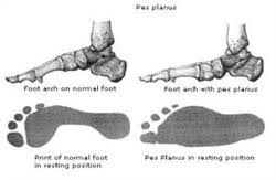 Pes Planus Flat Feet