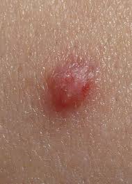 É importante ressaltar que muitas pessoas possuem o vírus do hpv e são assintomáticas e, apesar de não saber que possuem o vírus, essa pessoa é um vetor de o uso do preservativo masculino ou feminino em todas as relações sexuais também é uma forma de se prevenir das ists, como o hpv. Hpv Educa Mais Brasil