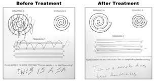 Image result for Thalamotomy