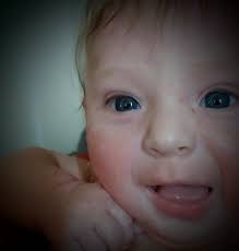 Sprengel's deformity or high scapula, is a congenital defect, where one's  scapula is abnormally located slightly higher as compare to the other  scapula!