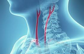 Carotid arteries are located in the anterior of the neck, on either side. Symptoms Treatment Of Carotid Artery Disease California Vein Vascular Centers