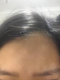 In accordance with the underlying causes, the condition can be signs and symptoms of poliosis include patches of white hair on any part of the body that has hair. Skin Concern White Patches On Forehead After Healing From A Sunburn Long Sun Exposure How Do I Fix This Skincareaddiction