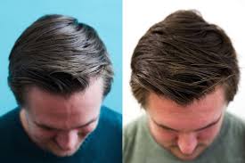 Hot water won't directly cause hair loss, but it can directly affect the health of your scalp. I Washed My Hair With Vodka For A Week Here S What Happened Thrillist