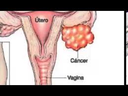 ¿cuáles son los síntomas del cáncer de útero? Que Es El Cancer De Cervix Sintomas Causas Y Como Referirse Solfa Syllable Enfermedad Sintomas De Cancer Al Utero Avanzado
