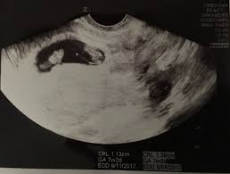 At 6 week ultrasound, the embryo is barely 0.25 inches, which is the size of a sweet pea. Missed Twins At 6 Week U S Found At 8 Weeks Babycenter