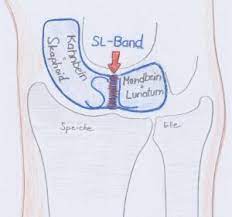 Sl Bandruptur Zentrum Fur Handchirurgie Nurnberg