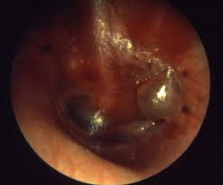 Image result for Acute Otitis Externa