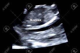 First Trimester Ultrasound Baby Xray Of Fraternal Twin Bladder Stock Photo Picture And Royalty Free Image Image 8496250