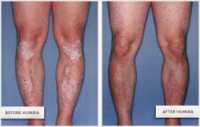 Pin On Back Pain Knee Pain Relief