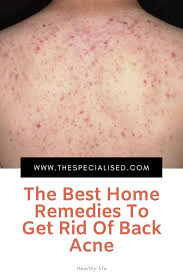 Lots Of People Take Care Of Zits Sooner Or Later Of Their Life Zits Can Seem Not Solely On The Face However On The Entire Physiqu Home Remedies Remedies Acne