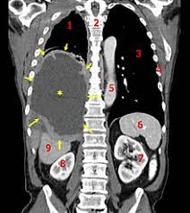 While symptoms can develop in the disease&#x27;s early stages, people often ignore them until they worsen. Mesothelioma Wikipedia