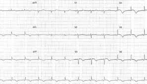 Ecg Case 083 In 2020 Cardiac Disease Self Assessment Takotsubo Cardiomyopathy