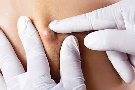 An ingrown hair irritates the skin. Is It Time To Consider Cyst Removal 7 Things To Know