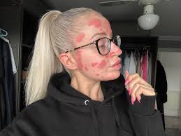 Few weeks of UV light therapy device, almost clear plus salt baths, green  smoothies, and 10000 IU of D3.