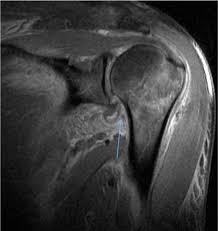 The abbreviation hagl can be used as a polite, but casual way of saying goodbye and wishing someone well if you think there's a chance. Bilateral Posterior Fracture Dislocation Of The Shoulders With Subscapularis Rupture And Hagl Lesion A Case Report