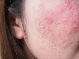 Image result for red rash face