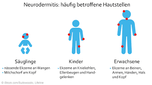 Neurodermitis Ursachen Symptome Behandlung