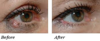 skin cancer is not uncommon in the eyelid areas. Eyelid Cancer Surgery St Petersburg Clearwater Fl Dr Kass