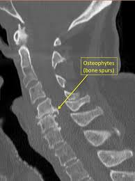 Cervical spine anatomy is quite complex. Cervical Spine Anatomy Diseases And Treatments
