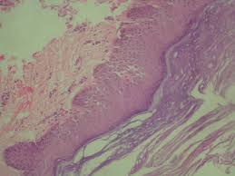 Sjogren Larsson Syndrome Importance Of Early Diagnosis And Aggressive Physiotherapy