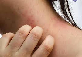 Image result for Atopic eczema atopic dermatitis