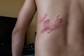 Image result for shingles in children
