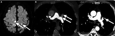 Image result for Decompression Sickness