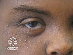 Image result for milium cyst on eyelid