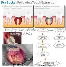 Image result for Alveolitis sicca)