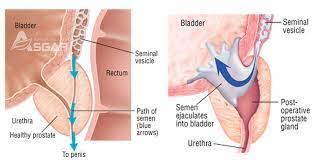 Ep is the result of what tissues are not removed. Retrograde Ejaculation Or Dry Orgasm Herbal Ayurveda Treatment In Trivandrum Kerala Asgar Healthcare Group