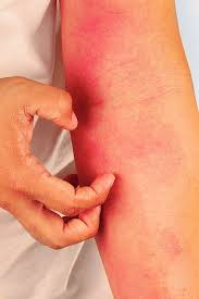 Image result for Neurodermatitis