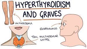 Understanding Hyperthyroidism And Graves Disease Youtube