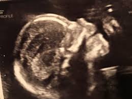 Velamentous and marginal cord insertion may be difficult to differentiate as the vessels in a velamentous cord lacking wharton's jelly are smaller and thinner than normal umbilical vessels. Marginal Cord Insertion Babycenter