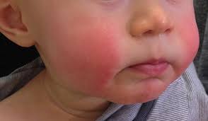 Image result for yellow scabs on the face in children