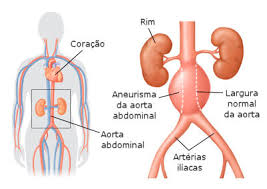 A exceção, em que não há o que pensar, é quando o aneurisma rompeu e já sangrou. Tenho Um Aneurisma De Aorta Abdominal E Agora