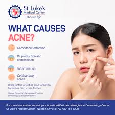 Having acne can be stressful. Know the reason behind your breakout by  consulting a St. Luke's Dermatologist. #StLukesPH #SLMCCultureofCare