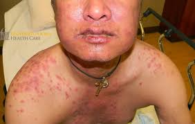 Stevens-johnson syndrome