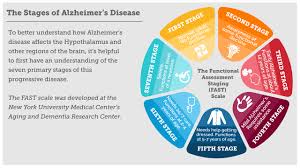 how alzheimers disease changes the brain my moment