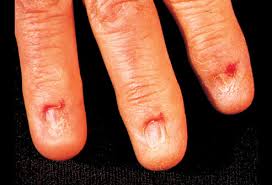My lichen planus is a community and resource for those that suffer from the autoimmune skin. Lichen Planus 2 Picture Image On Medicinenet Com