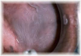 Image result for Leukoedema