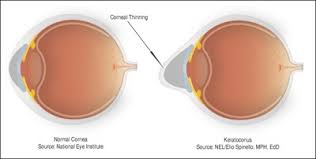 Image result for Cornea